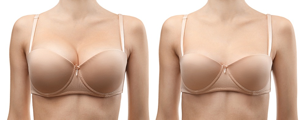 Woman before and after breast size correction