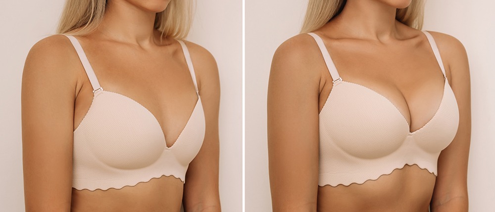 Before and after breast augmentation results